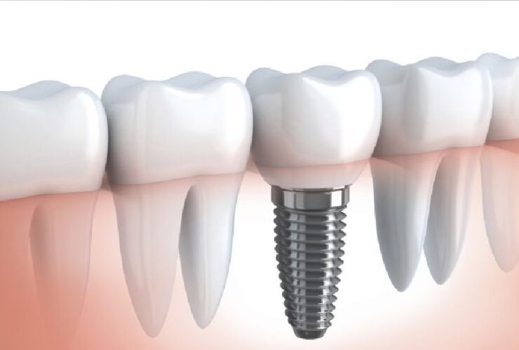 implantes dentales